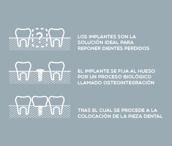 PRÓTESIS SOBRE IMPLANTES: UNO DE LOS TRATAMIENTOS ESTRELLA DE LA CLÍNICA DENTAL BRASILOCHO