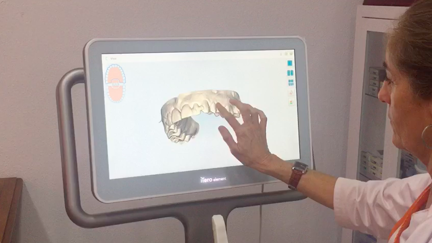 Estrenamos nuevo escáner intraoral para el diseño digital de la sonrisa de nuestros pacientes