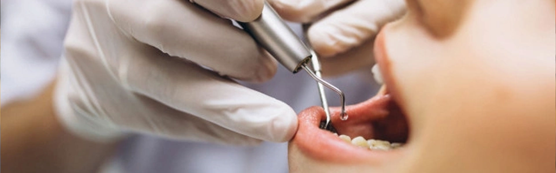 Odontología restauradora - Clínica dental Brasilocho - Clínica dental Cádiz - Odontología - Dentistas en Cádiz