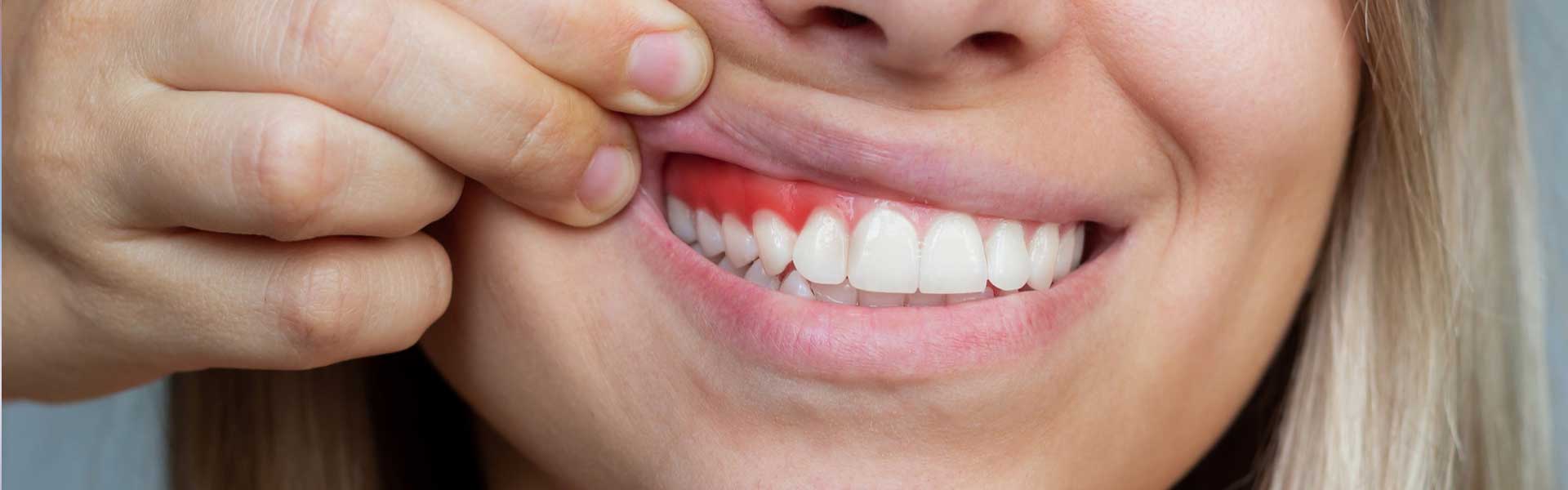 Encías - Clínica dental Brasilocho - Clínica dental Cádiz - Odontología - Dentistas en Cádiz